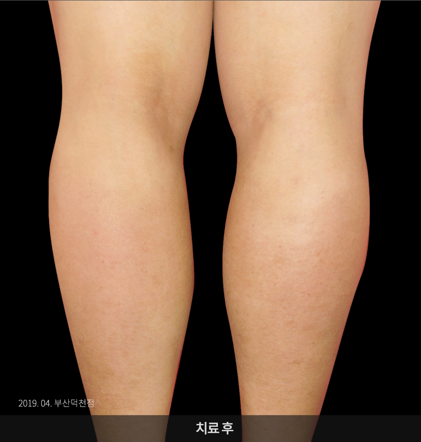 화폐상 습진 치료 후 사진