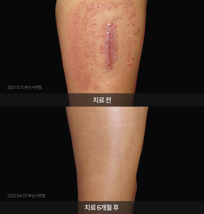 습진 치료 전후 사례