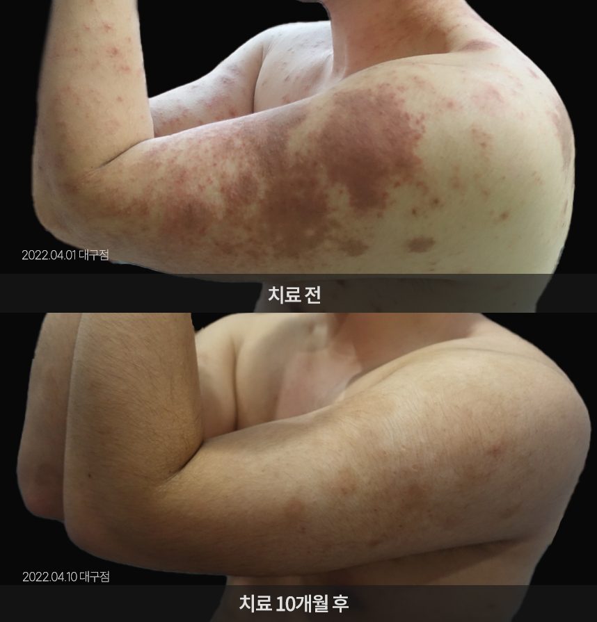 습진 치료 전후 사례