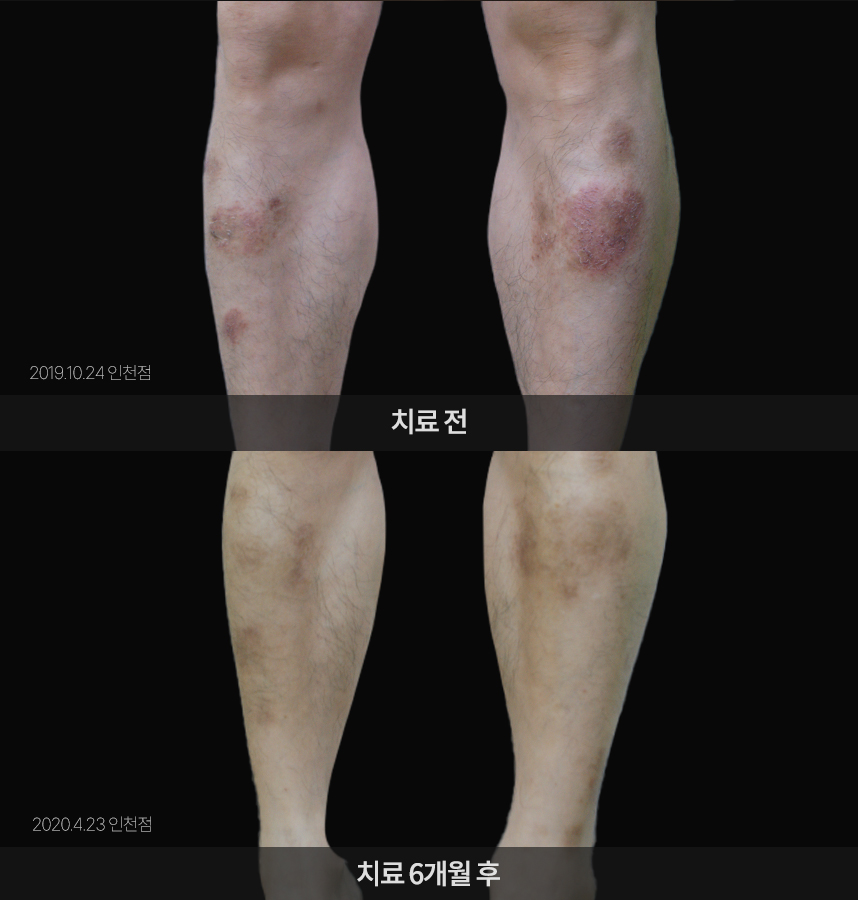 습진 치료 전후 사례