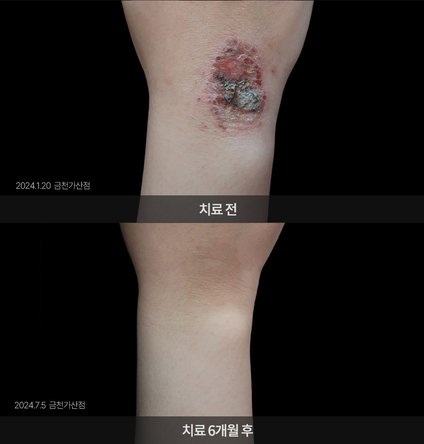 습진 치료 전후 사례