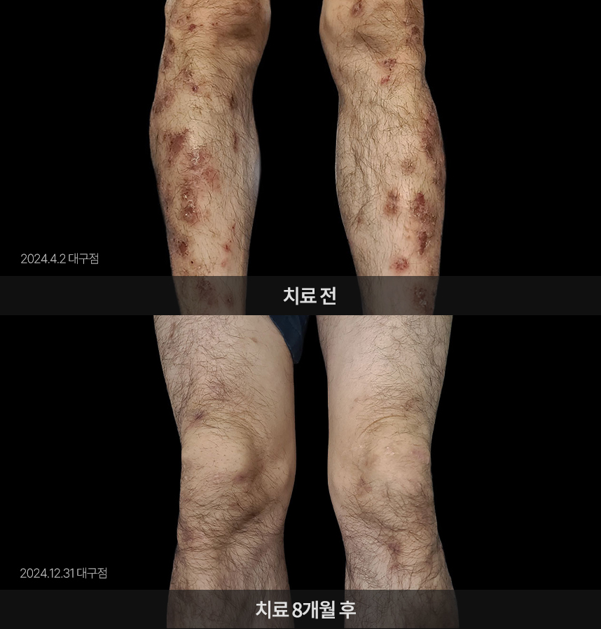 습진 치료 전후 사례