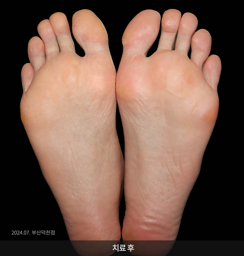 사마귀 치료 후 사진