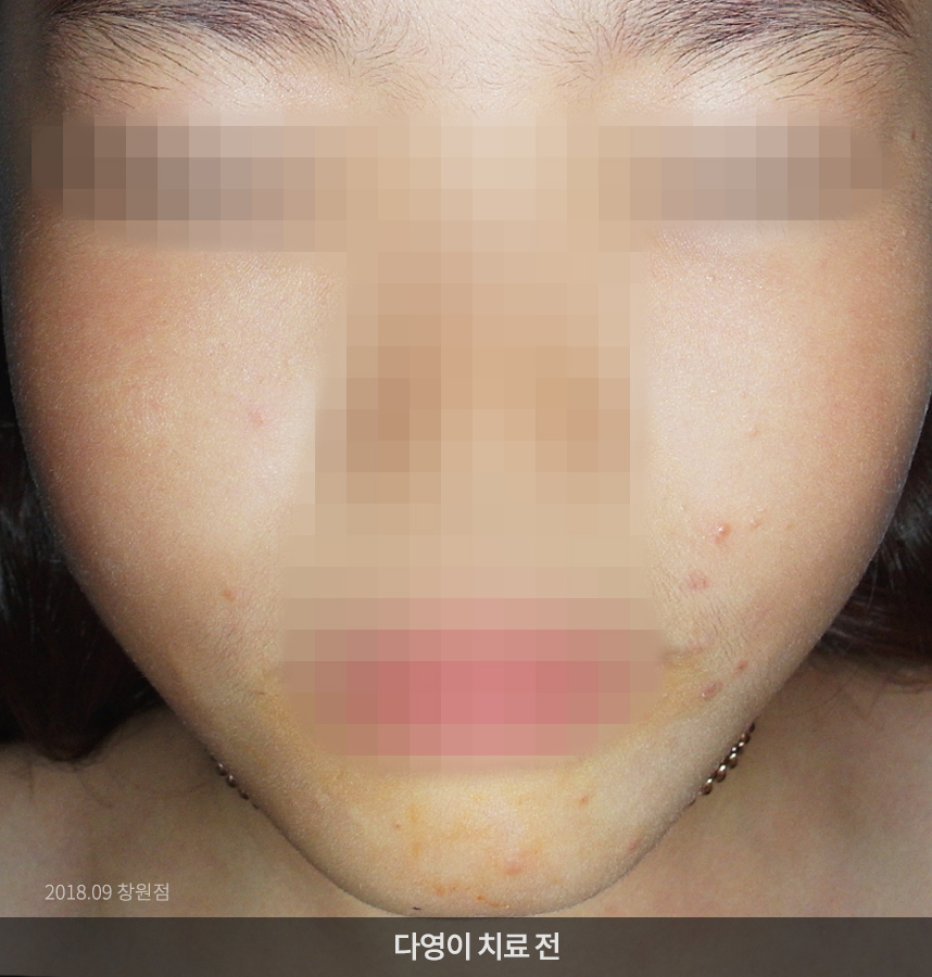 사마귀 치료 전 사진