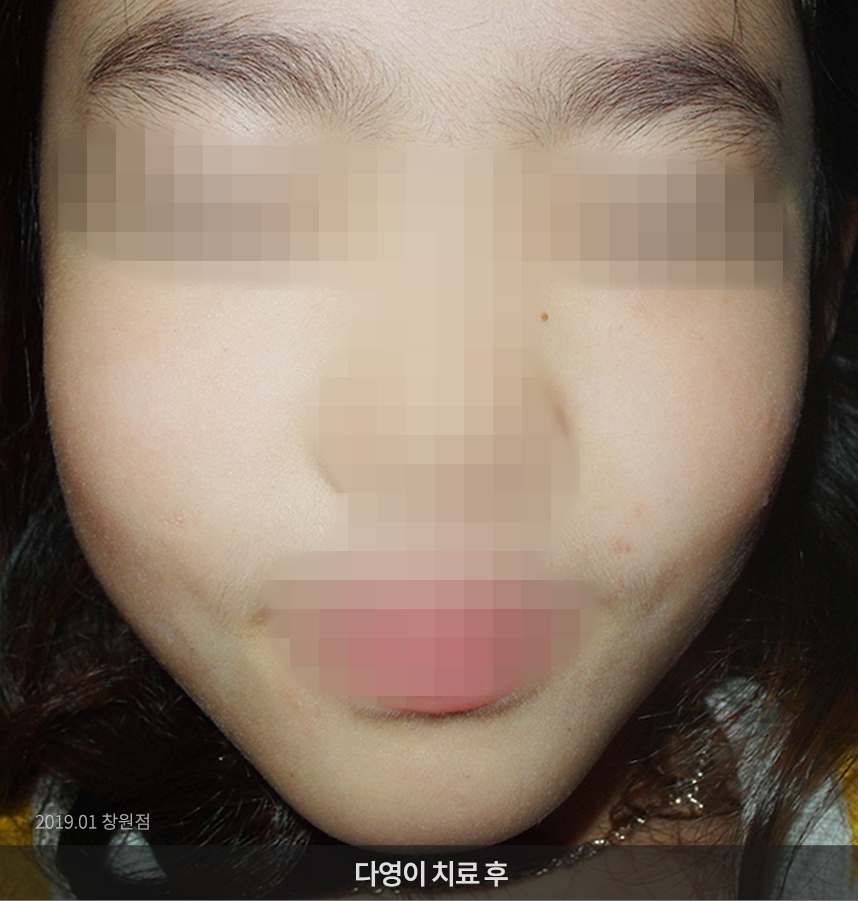 사마귀 치료 후 사진