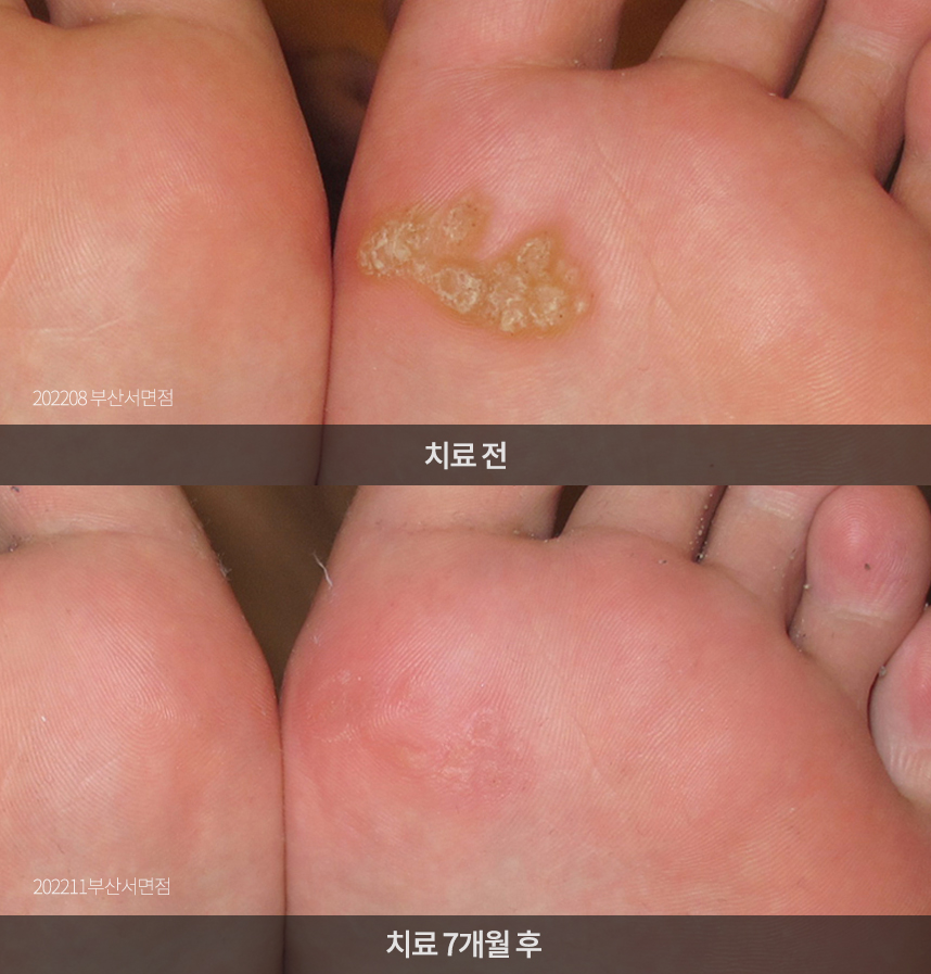 사마귀 치료 전후 사례