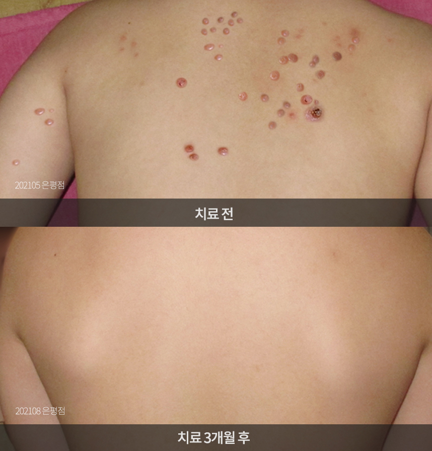 사마귀 치료 전후 사례