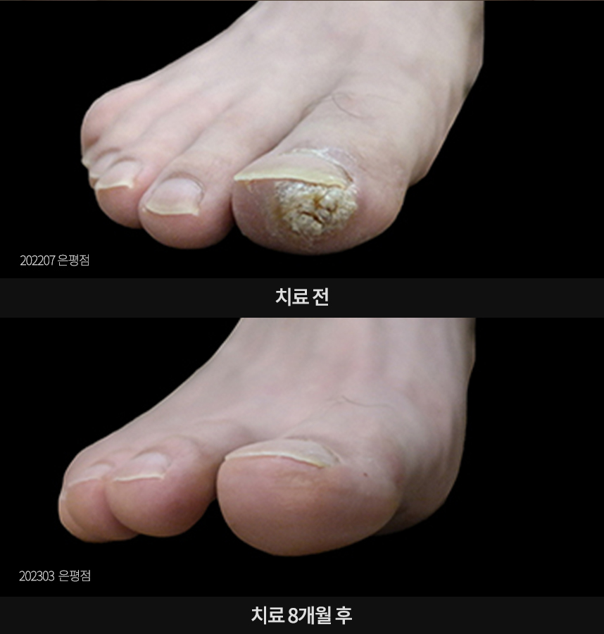 사마귀 치료 전후 사례