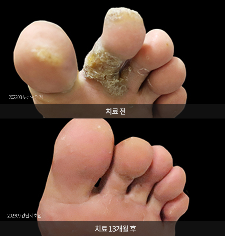 사마귀 치료 전후 사례