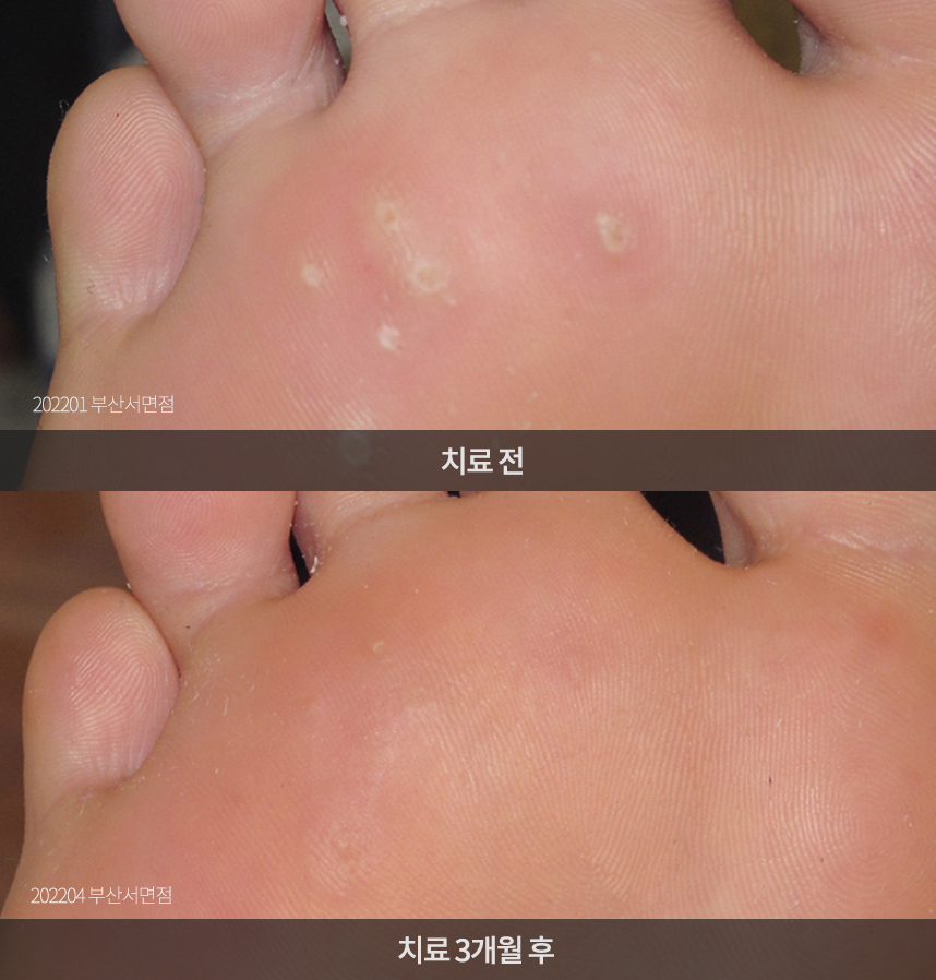 사마귀 치료 전후 사례