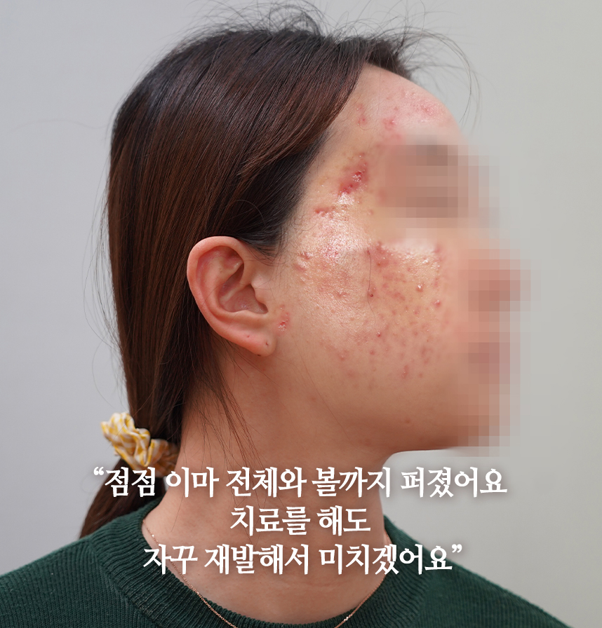 온몸이 여드름으로 뒤덮힌 환자