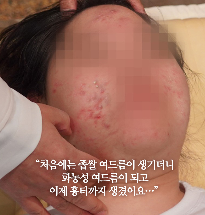 여드름 치료 전 사진