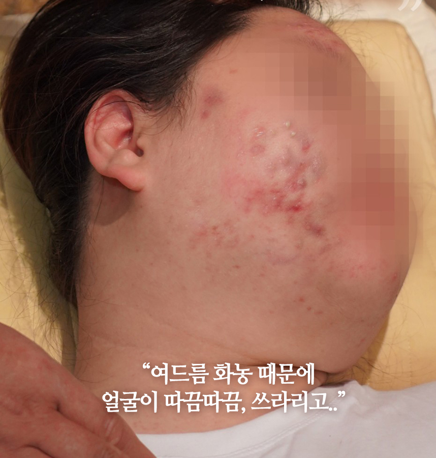 여드름 치료 전 사진
