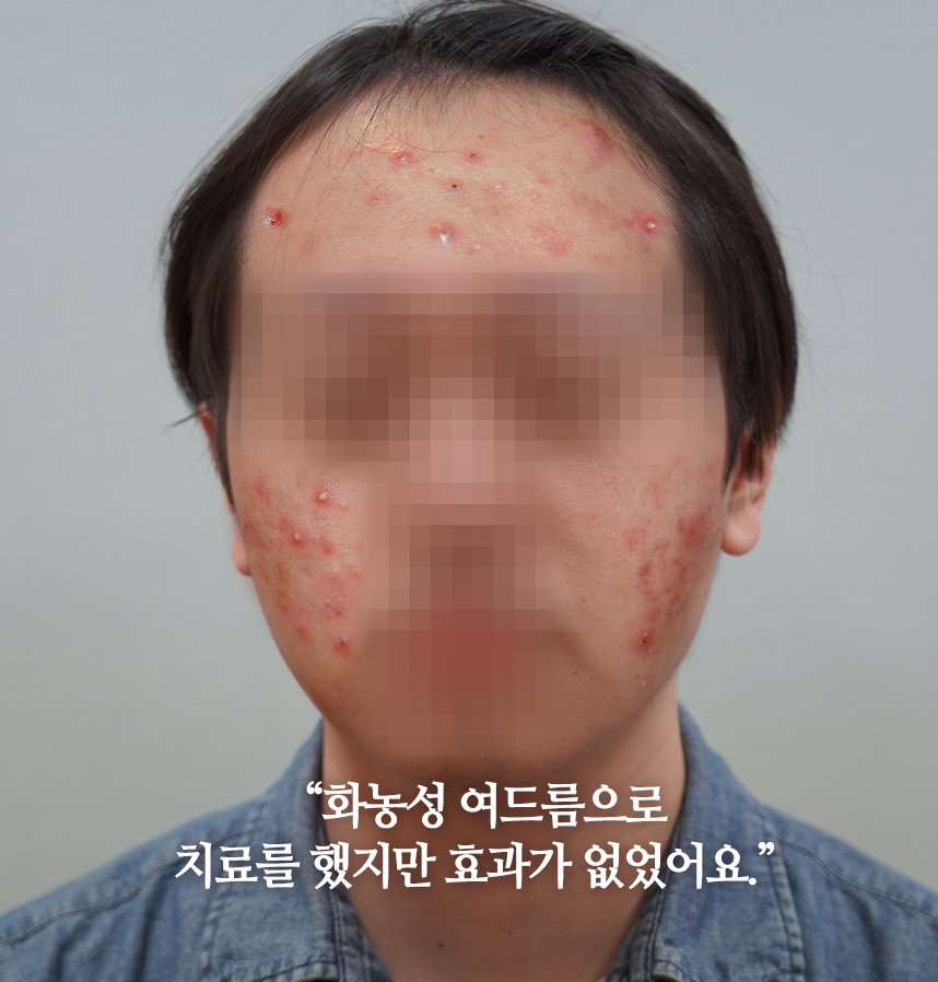 여드름 치료 전 사진