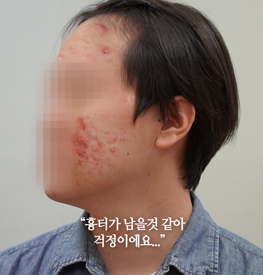 여드름 치료 전 사진