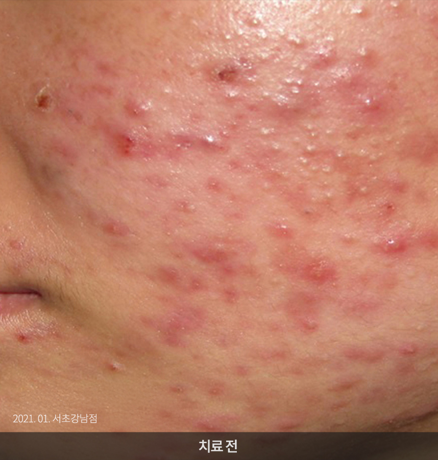 여드름 치료 전 사진