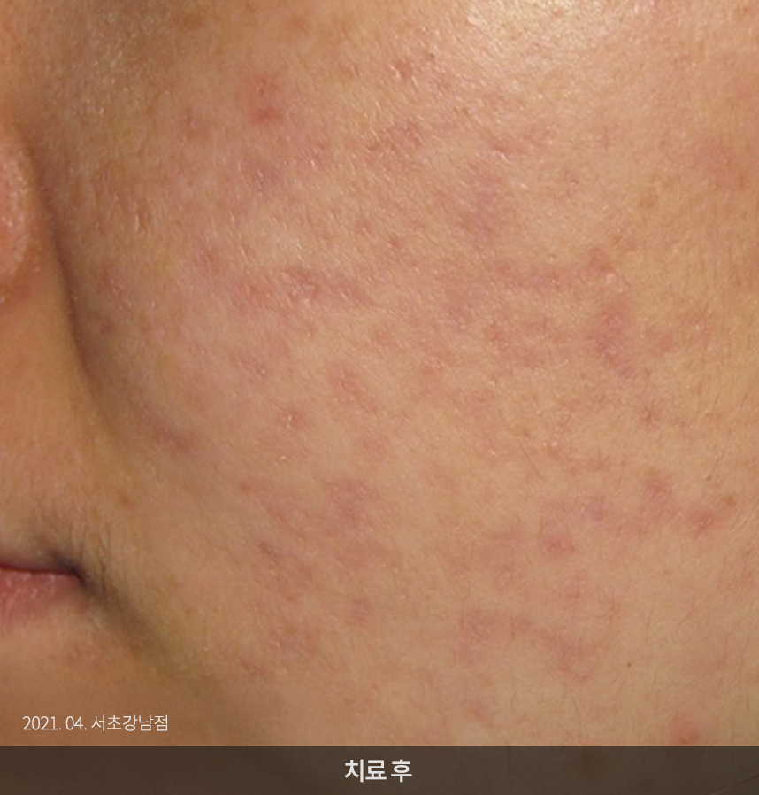 여드름 치료 전 사진