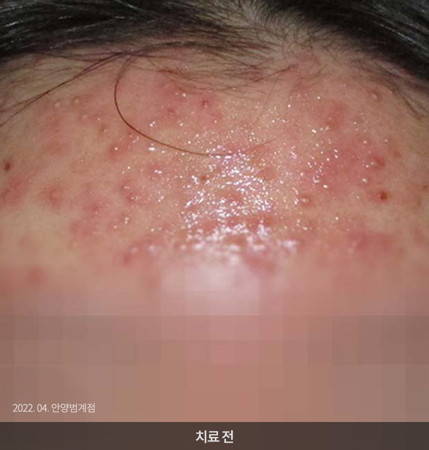 여드름 치료 전 사진