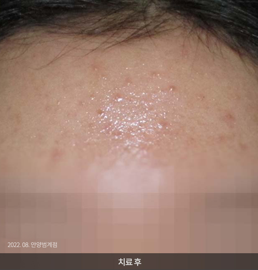 여드름 치료 전 사진