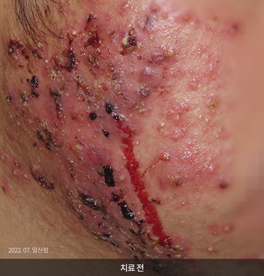 여드름 치료 전 사진