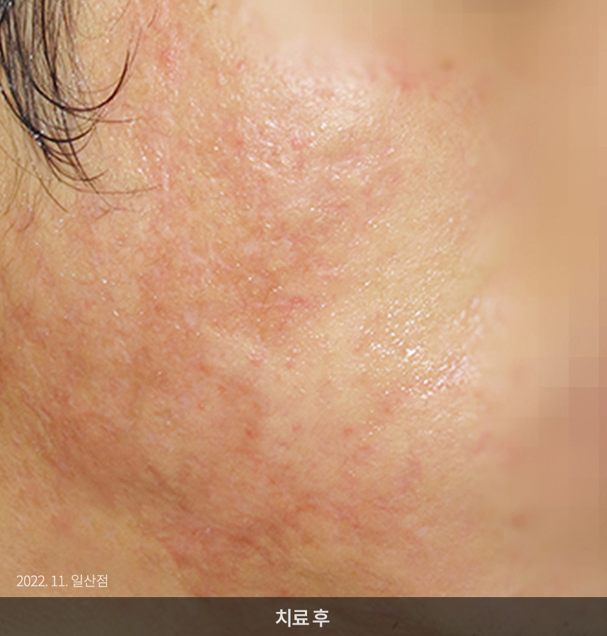 여드름 치료 전 사진