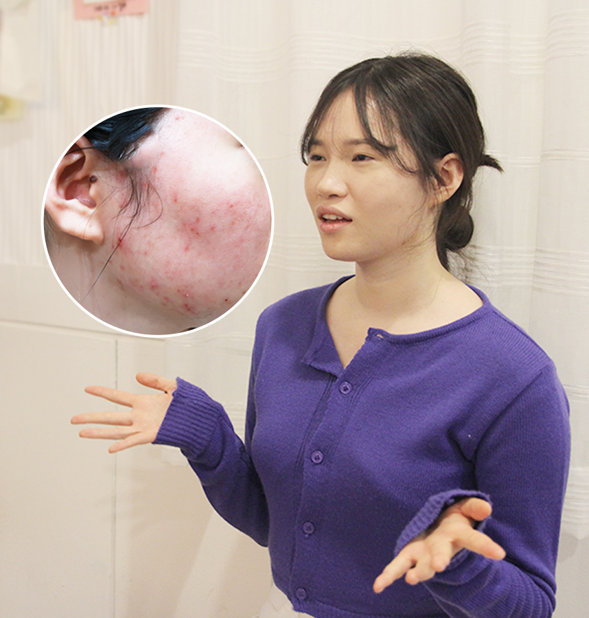 여드름 이야기