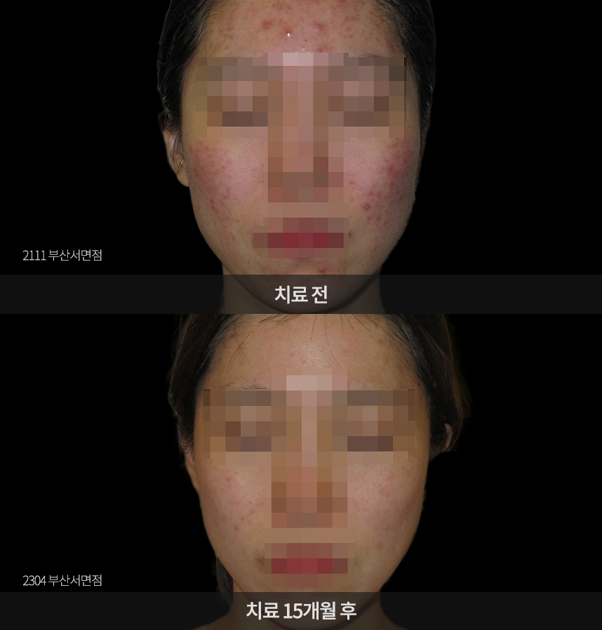 여드름 치료 전후 사례