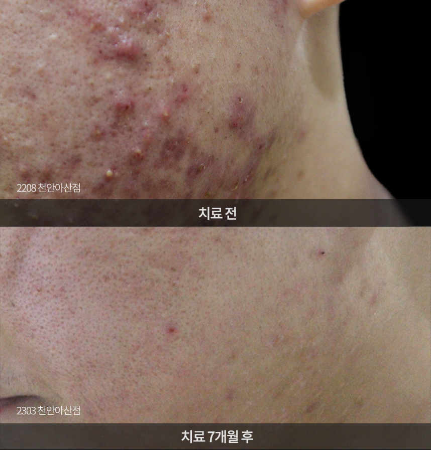 여드름 치료 전후 사례