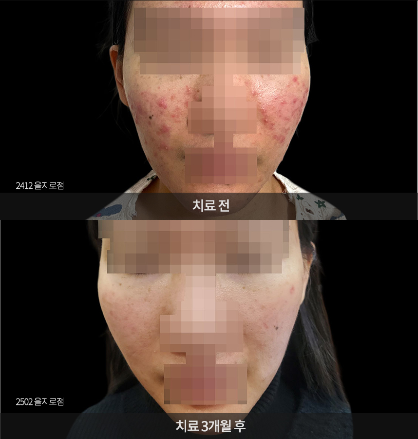 여드름 치료 전후 사례
