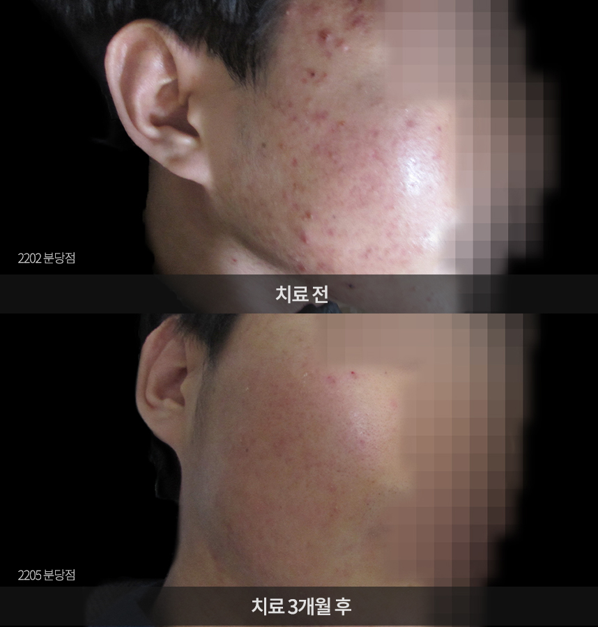 여드름 치료 전후 사례