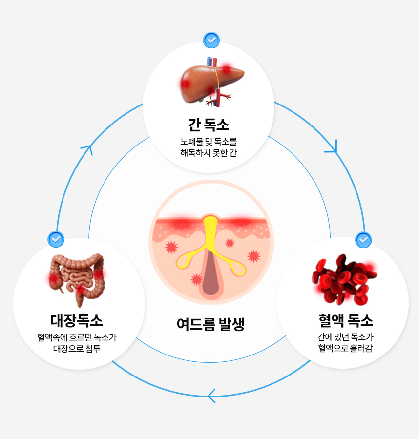 여드름 피부의 발생과정