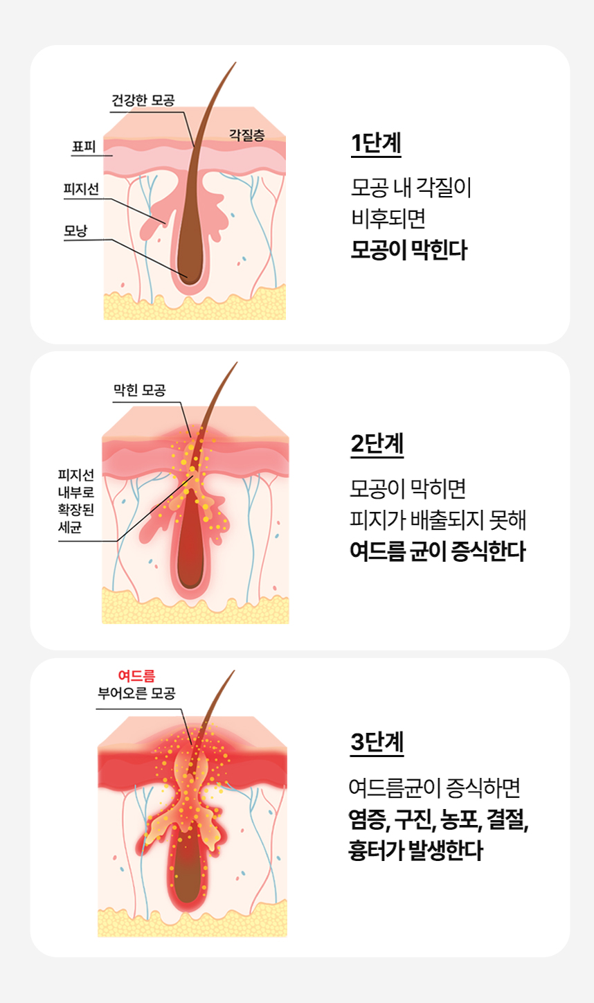 여드름 피부의 원인