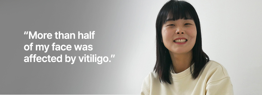 얼굴의 반 이상이 백반증이었어요.