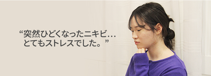 The sudden worsening of my acne was so stressful.