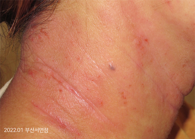 Before Treatment of Urticaria