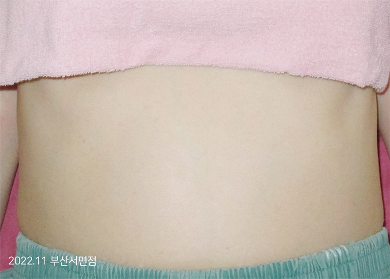 After Treatment of Urticaria