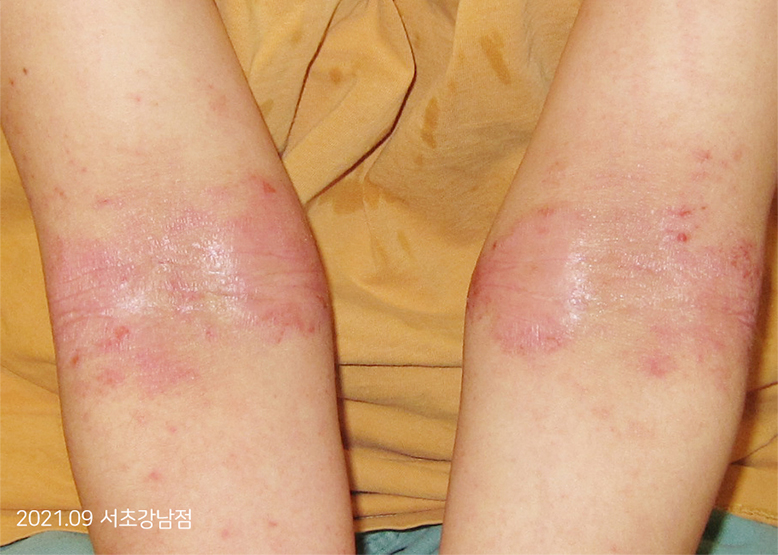 Before Treatment of Urticaria