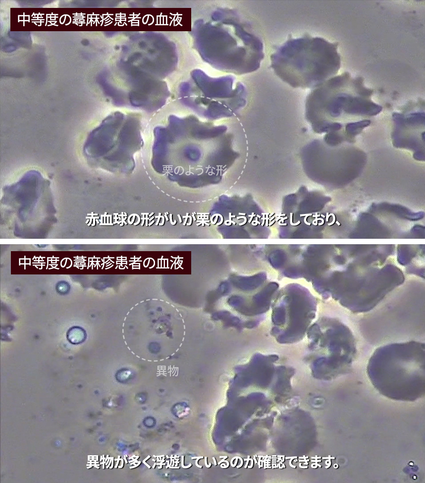 Blood of a patient with severe urticaria