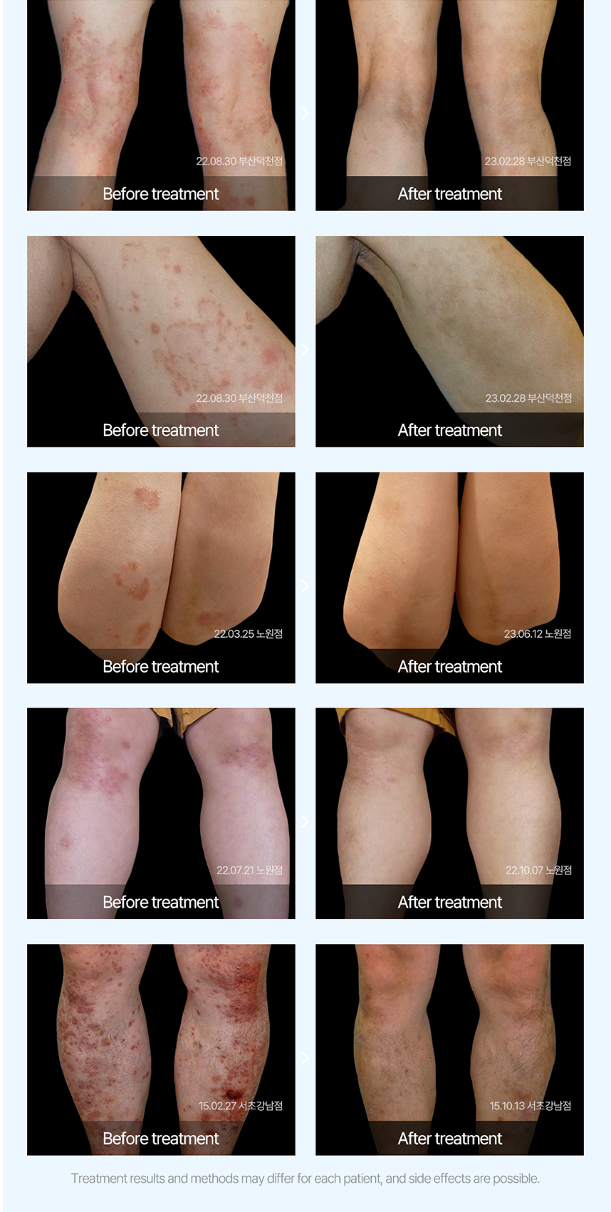 건선 치료 전후 사례