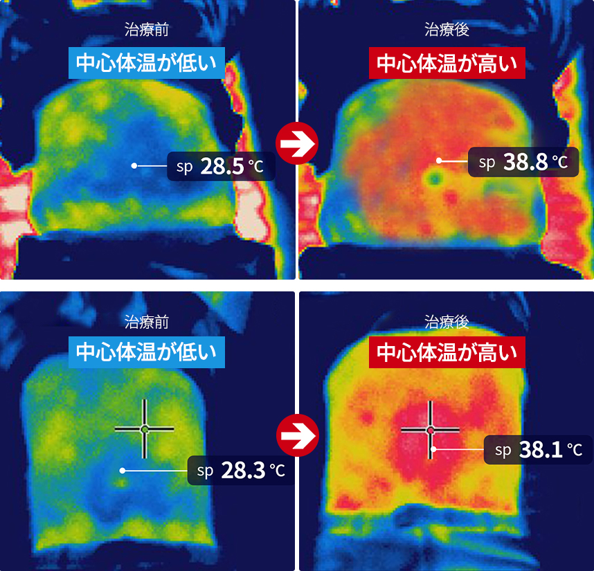 High-Frequency Thermal Therapy