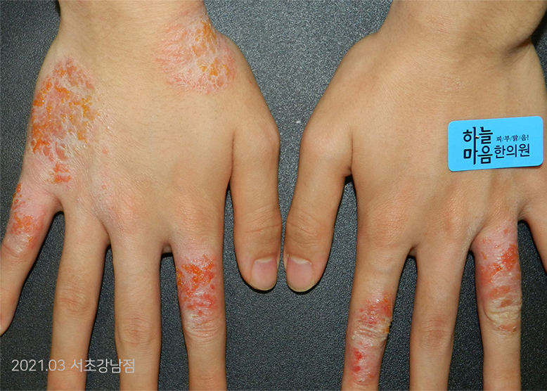 Before Treatment of Dyshidrotic eczema