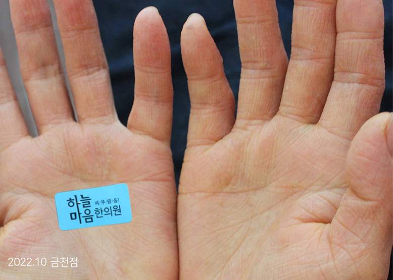 After Treatment of Dyshidrotic eczema