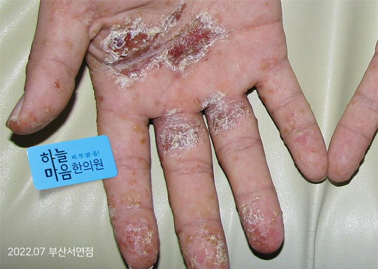 Before Treatment of Dyshidrotic eczema