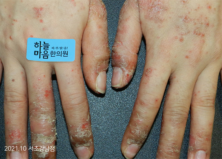 Before Treatment of Dyshidrotic eczema