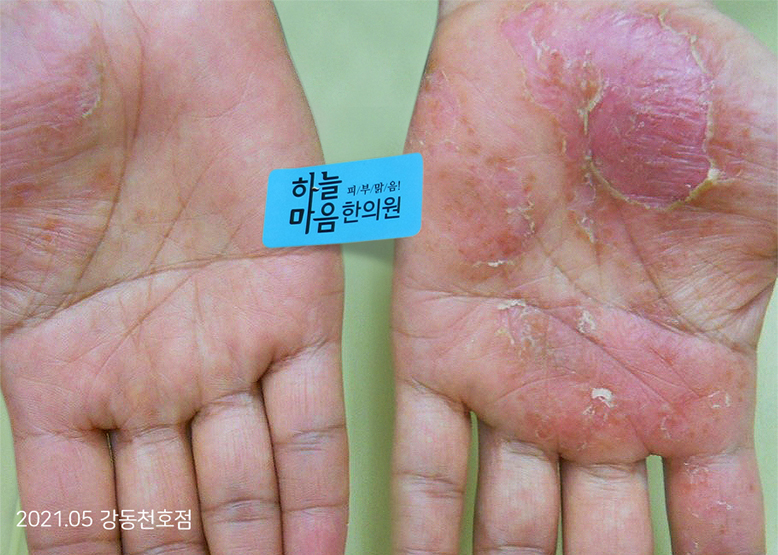Before Treatment of Dyshidrotic eczema