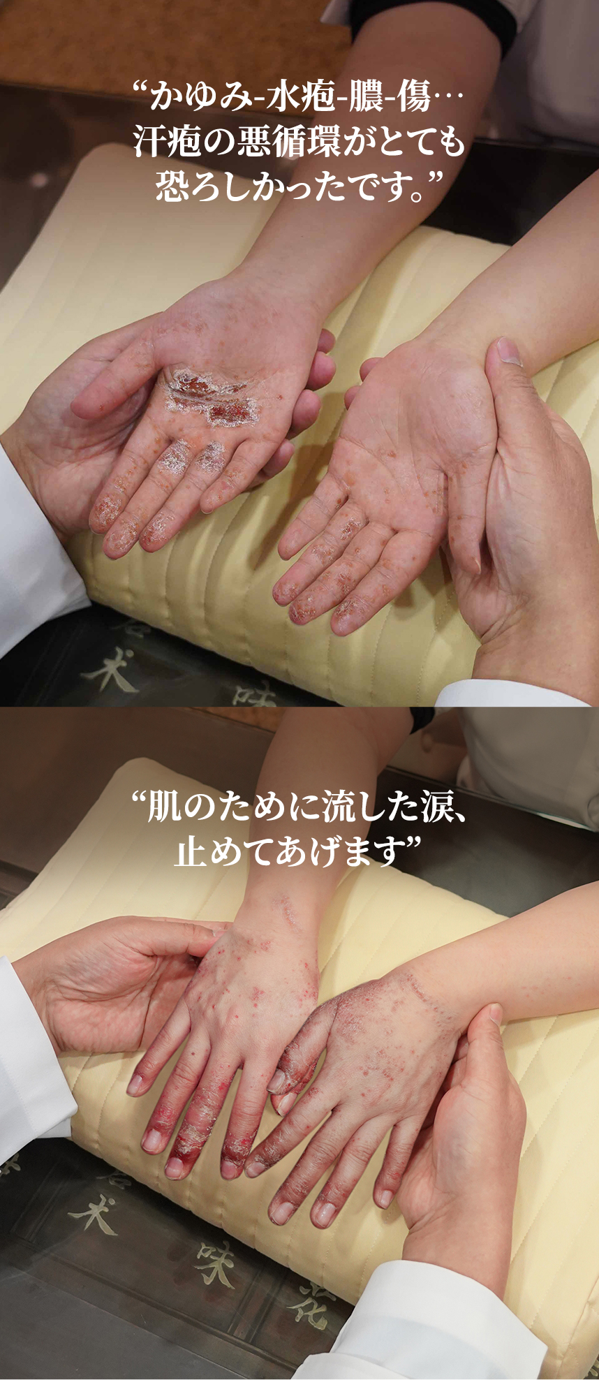 It was terrifying to be trapped in the vicious cycle of itching-blisters-oozing-wounds with dyshidrotic eczema. Stop shedding tears over your skin.