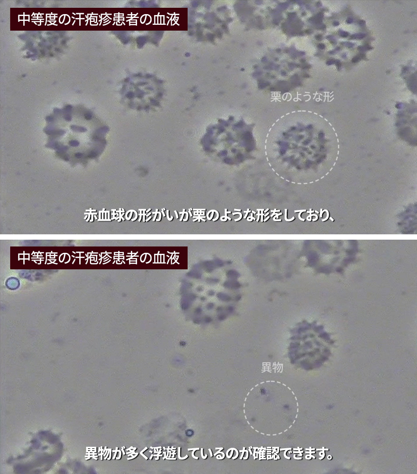 Blood of a patient with severe dyshidrotic eczema 
