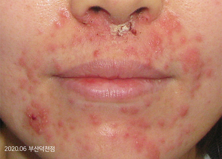 Before Treatment of Seborrheic Dermatitis