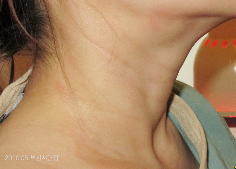 After Treatment of Seborrheic Dermatitis