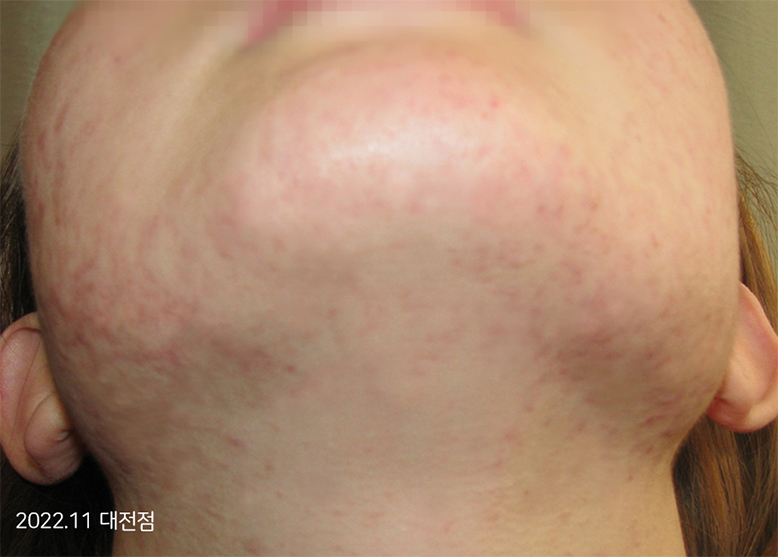 After Treatment of Seborrheic Dermatitis